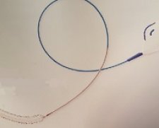 Medtronic Abre venous self expanding stent system | Which Medical Device